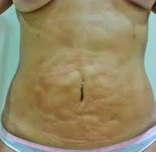 FIBROSES NO PÓS OPERATÓRIO